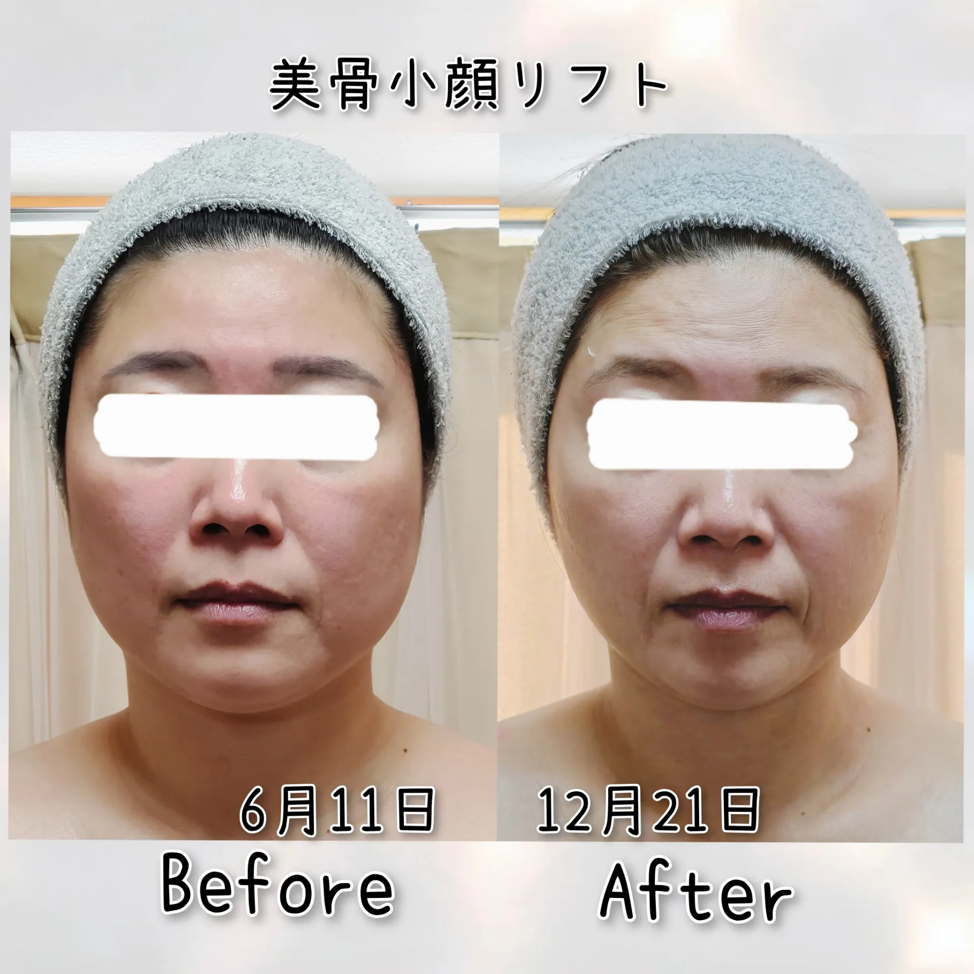 美骨小顔リフト【茨城県古河市エステサロン】